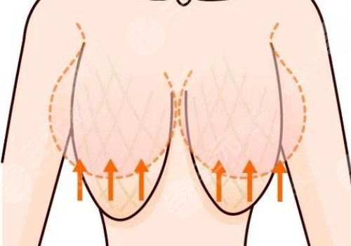 上海九院做胸下垂缓解好吗，多少钱