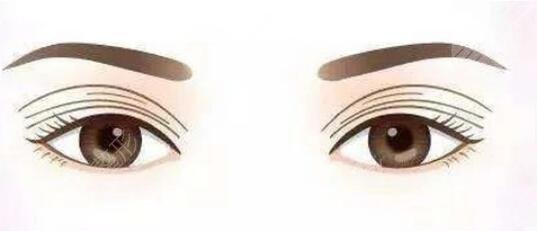 双眼皮