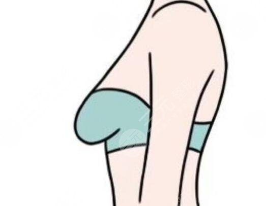 乳房下垂矫正