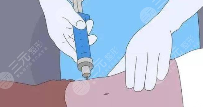 杨浦区中心医院整形美容科腰腹环吸案例