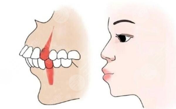 正颌