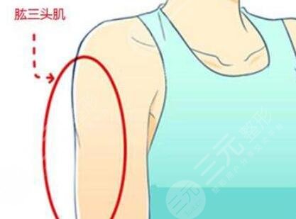 手臂吸脂