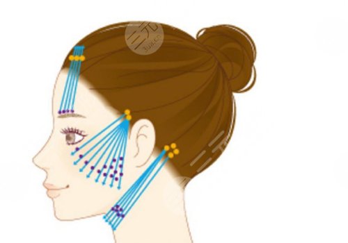 人工韧带提升面部下垂安全吗