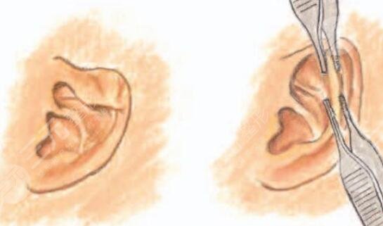 北京八大处林琳再造耳技术怎么样?