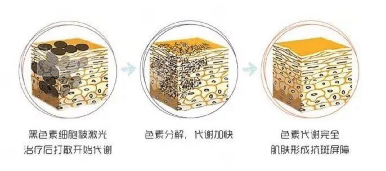 上海第八人民医院激光去雀斑案例分享