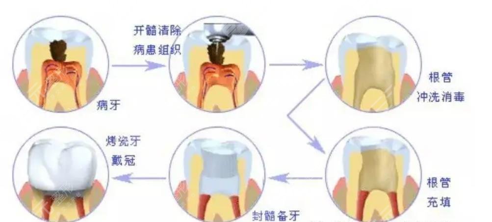 上海第六人民医院牙齿做根管案例分享