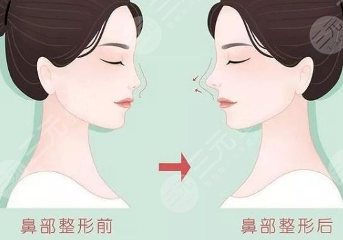 上海第九医院隆鼻前后对比