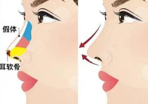 上海第九医院隆鼻前后对比