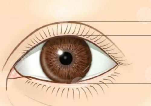 许莲姬双眼皮多少钱