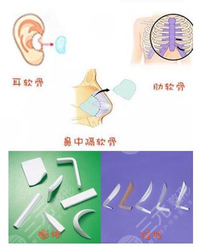 李哲权医生隆鼻整形案例