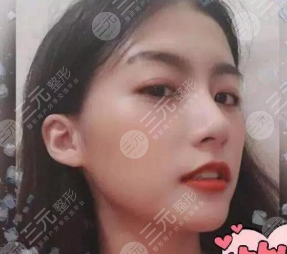 西南医院刘剑毅隆鼻案例