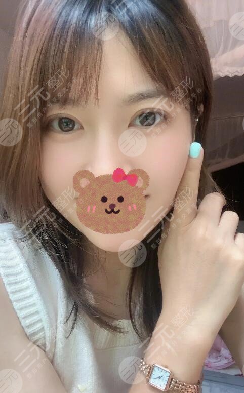 上海第一人民医院眼整形科双眼皮案例