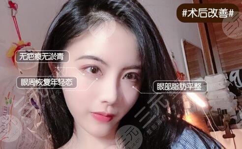 重庆第四人民医院双眼皮案例