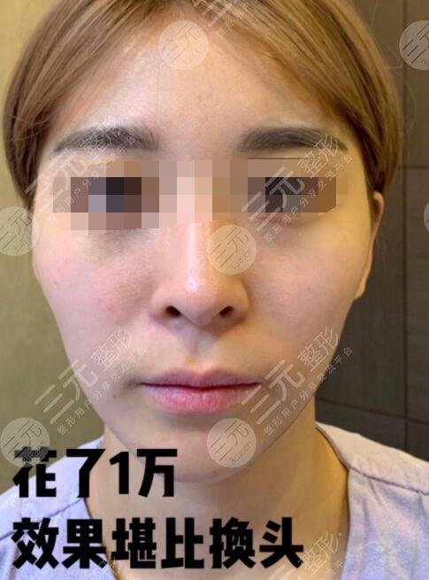 自体脂肪丰额头亲身经历讲述