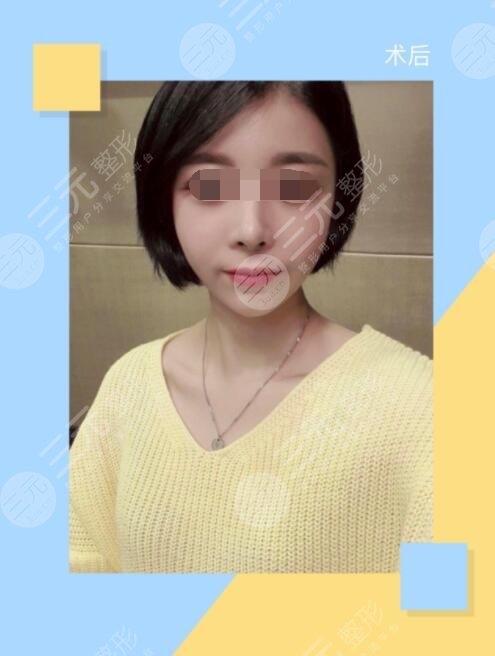 做自体脂肪丰额头手术一个月以后