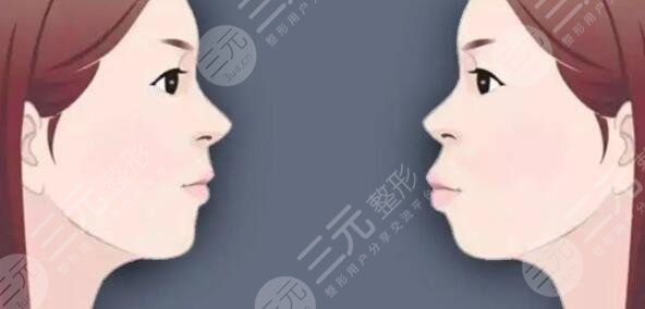 正颌手术