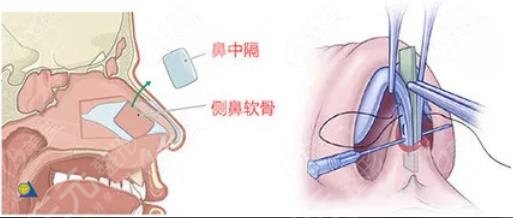 郑若冰鼻子整形怎么样