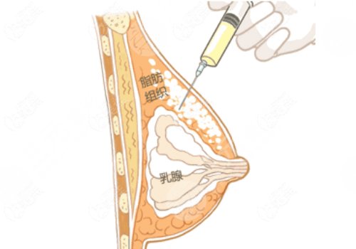 抽脂丰胸有什么风险和后遗症术后多久定型美胸必看
