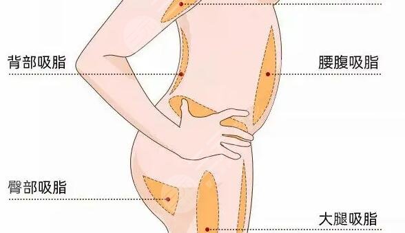 吸脂