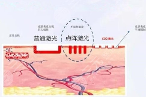 四川省人民医院祛疤案例