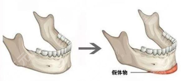 垫下巴
