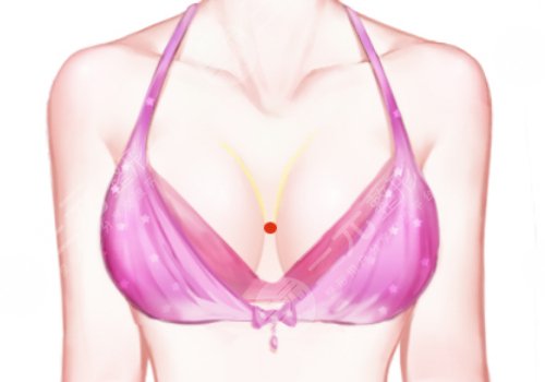 乳房假体取出手术费用