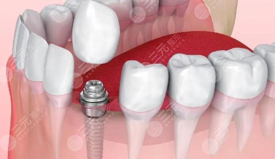 重庆新桥医院种牙案例