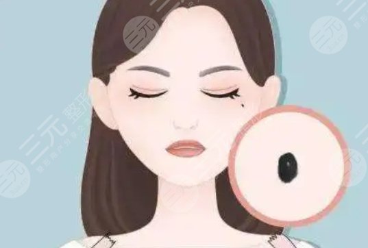 上海同济医院激光去痣案例