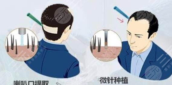 阜阳市人民医院植发案例
