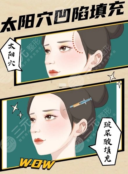 刘卓医生玻尿酸填充太阳穴案例