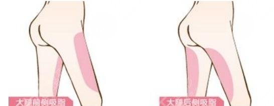 大腿抽脂