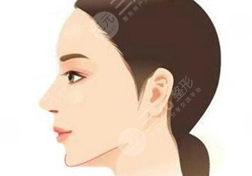 短下巴整形手术多少钱