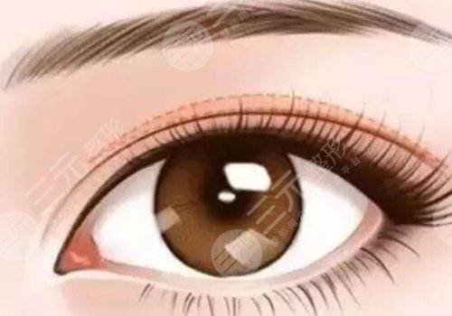 覃方燕做双眼皮怎么样