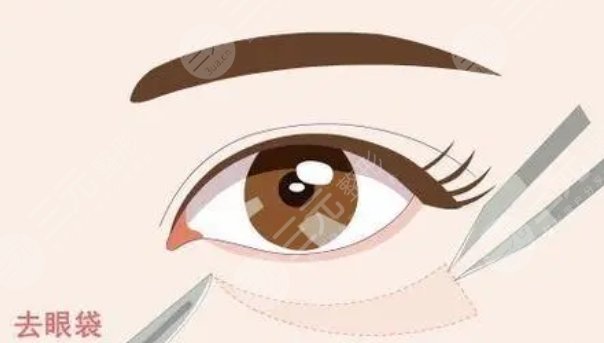 武汉同济医院去眼袋案例