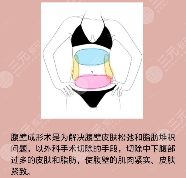 腹壁成形