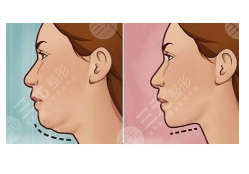 整容下巴需要花费多少钱呢
