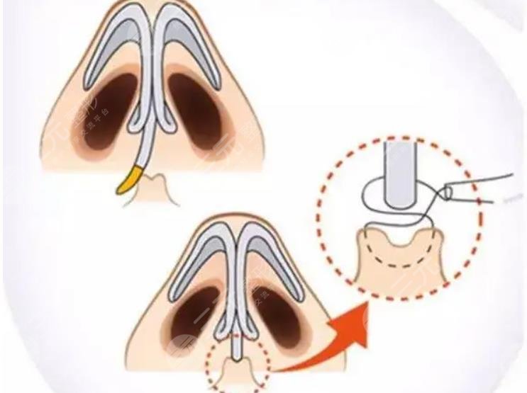 成都周顺波隆鼻案例