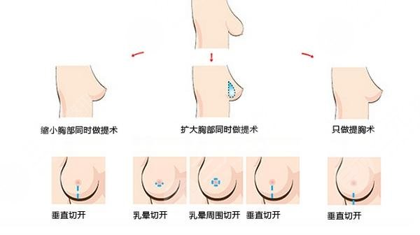 隆胸