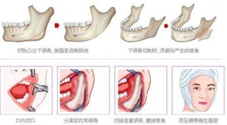 磨骨