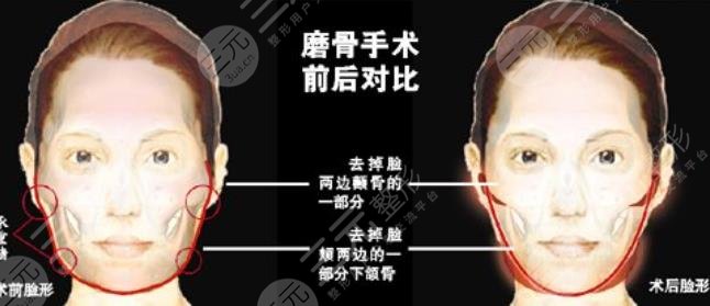 磨骨术