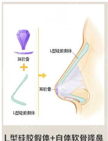 垫鼻基底