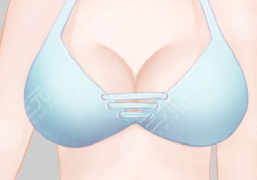 乳房下垂上提手术大约多少钱