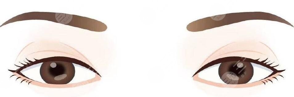 双眼皮