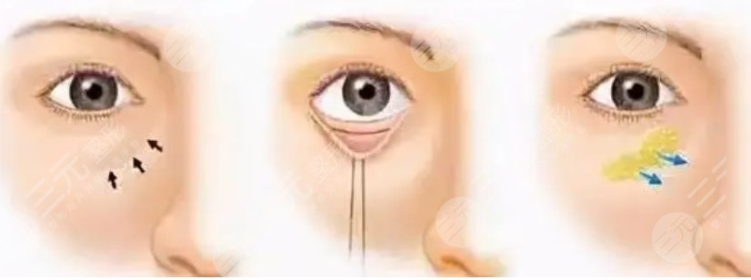 重庆西南医院做眼袋手术案例