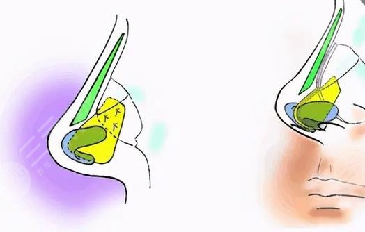 高顺福做鼻子案例参考