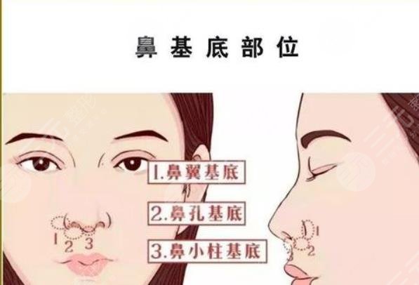 垫鼻子