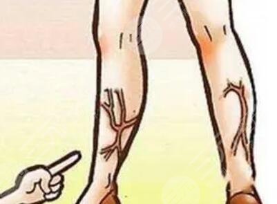 祛疤