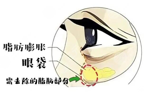 去眼袋
