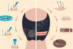 脱发1-7级程度图片好不好？含有详细的科普知识来啦