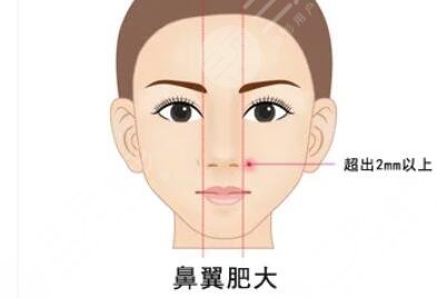 鼻翼缩小